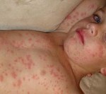 measles (Copy)